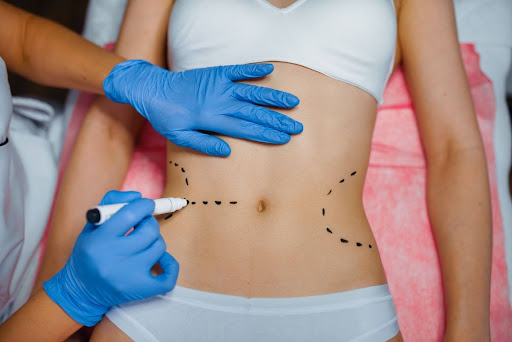 How Much Does a Belt Lipectomy Cost in Texas?