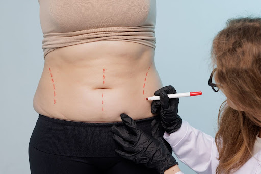 How Much Does it Cost for Liposuction in Austin, Texas?